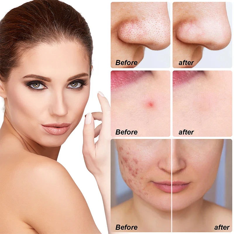 Large Hydrocolloid Patch Acne Removal Full Face Pimple Patches Protect Skin Face